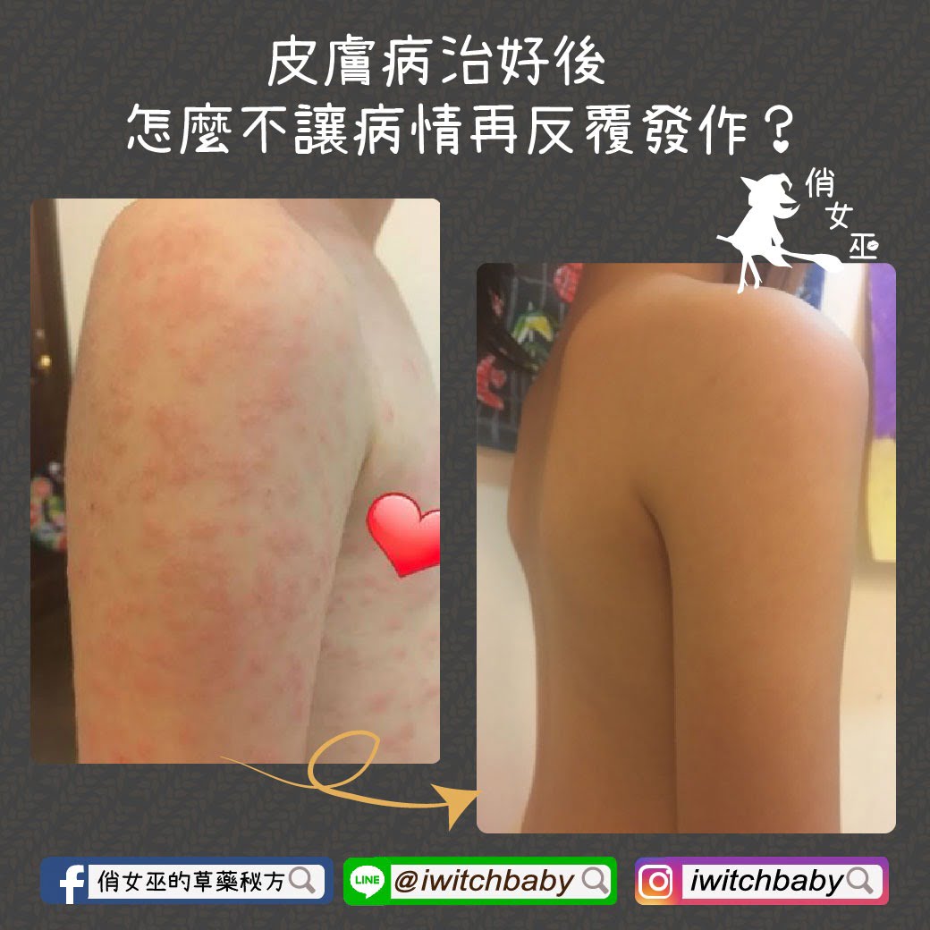 皮膚病治好後,怎麼不讓病情再反覆發作?